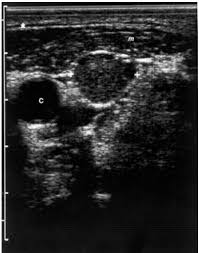 Ultrasound is not usually performed as a routine screening test for thyroid nodules in the general population. Ultrasonography Of The Thyroid Endotext Ncbi Bookshelf