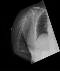 Humerus nail manufacturers and suppliers. Elastic Stable Intramedullary Nailing As A Treatment Option For Comminuted Proximal Humeral Shaft Fractures In Adults A Report Of Two Cases And A Review Of The Literature Alshammari An Altayeb Ma Alnazer