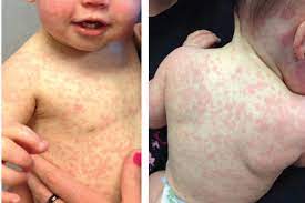 Child S Rash After Penicillin Sensitivity Or Something Else Consultant360