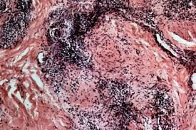 Although there is no known cause for any type of sarcoidosis, it is thought that both genetics and environmental factors play a. Cicatricial Alopecia Due To Sarcoidosis