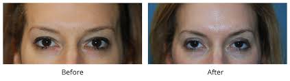 Eyelid Surgery