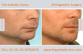 Maybe you would like to learn more about one of these? Orthognathic Surgery Jaw Correction Surgery Cost In India The Esthetic Clinics