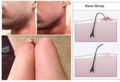 A hair caught in your skin is an ingrown hair. Pin On Health