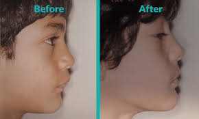 I'M The Real Life Jaws': Student, 36, Has Condition Which Means His Jaw  Bone Won'T Stop Growing | Daily Mail Online