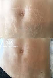 It is advisable to wait for your stretch marks to heal for at least a year before you can tattoo over them. Tattoo Artist Hides Stretch Marks With Skin Colored Ink Before And After Photos Allure
