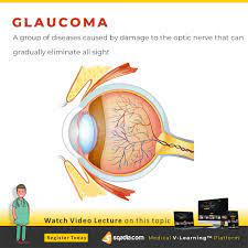 Knowing the basics of glaucoma is the first step to protecting your vision. Pin On Sqadia Com Ophthalmology