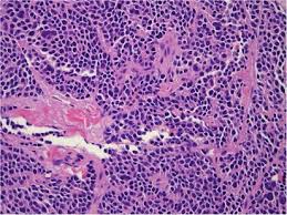 Image result for Merkel Cell Carcinoma