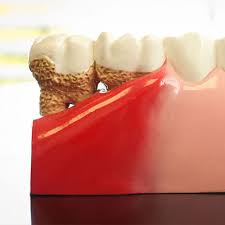 Salt is a natural disinfectant that helps your body to heal itself. Gingivitis Gum Disease Childrens Dental Zone