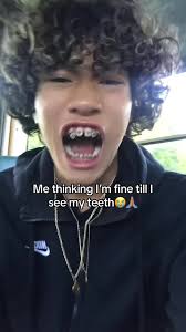 He’s So Embarrassed Of His Teeth?! 🤯😭🤷 #fyp #teeth #dentistry #braces  #health #reaction