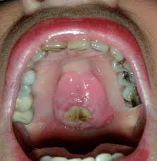 Image result for Erythroplakia roof of mouth