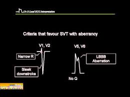 Vt vs svt with aberrancy explained simply , stepwise so that you understand! 12 15 Lead Ecg Vt Vs Svt Youtube