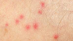 Mosquito Bite Allergies Symptoms And Treatment