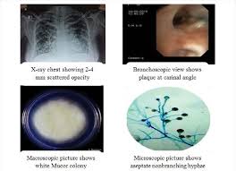 It is caused by exposure to mucor mould which is commonly found in soil, plants, manure, and decaying fruits and vegetables. Clinical Observation Of Mucormycosis Download Scientific Diagram