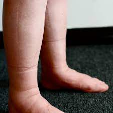 How To Reduce Water Retention | Causes Of Fluid Retention - Hubpages