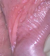 If it becomes cancer, then there may be some symptoms. Presence Of Human Papillomavirus In Semen Of Healthy Men Is Firmly Associated With Hpv Infections Of The Penile Epithelium Fertility And Sterility