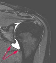 Schultersteife Frozen Shoulder Schulthess Klinik