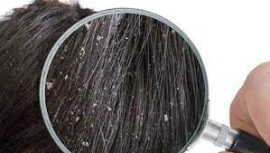 This will reduce your urge to scratch and protect your hair follicles against further damage. Ayurveda For Dandruff 5 Home Remedies To Beat Dandruff Naturally Ndtv Food