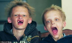 Real-life Twilight: Cullen brothers have rare 'vampire-like' syndrome