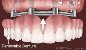 Dental Implants And Periodontal Disease General And Cosmetic Dentist