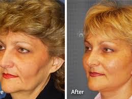 Facelift Before And After Photos