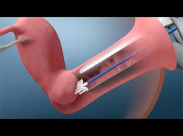 Image result for Pap Smear