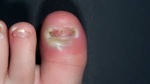 Image result for Paronychia feet