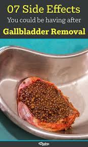 Many Doctors Ignore The Importance Of Gallbladder Like Its Inessential For Your Body Or Wellbeing But The Tru Gallbladder Surgery Galbladder Diet Gallbladder