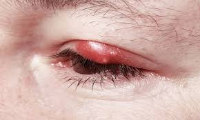 It Dirsegi Arpacik Nedir It Dirsegi Nasil Gecer Saglik Gozler