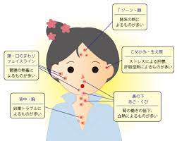 大人ニキビ ニキビができる場所で貴方のウィークポイントがわかる ニキビ 場所 大人ニキビ ニキビ