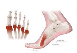 Image result for Metatarsalgia