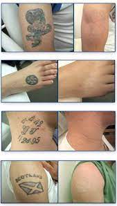 New zealand's leading laser tattoo removal clinic. Tattoo Removal Before And After Tattoo Removal Laser Tattoo Tattoo Removal Cost