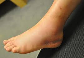Duuuuh, pas lagi make' sepatu, mau berangkat ke kantor. Cara Mengatasi Kaki Bengkak Saat Hamil Kesehatancenter Over Blog Com