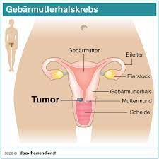 Gebarmutterhalskrebs Tumore Erkennen Bevor Sie Entstehen Gesundheit Rnz