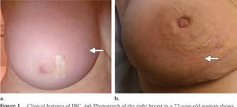 Image result for Inflammatory breast cancer
