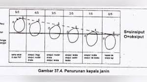 Contoh soal partograf dan cara mengerjakannya di perkuliahan kita sering diberi soal partograf untuk mengerjakannya di lembar partograf. 10 05 Mb Cara Pengisian Partograf Download Lagu Mp3 Gratis Mp3 Dragon