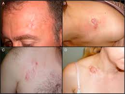 Image result for Dermatofibrosarcoma Protuberans