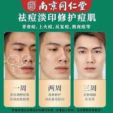 Acne acne acne acne fade acne mark aloe acne cream 30g