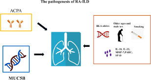 Rheumatoid Arthritis Associated Interstitial Lung Disease An Overview Of Epidemiology Pathogenesis And Management Springerlink
