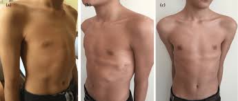 The condition affects more boys than. A C Preoperative View Of A Case With Pectus Carinatum A Download Scientific Diagram