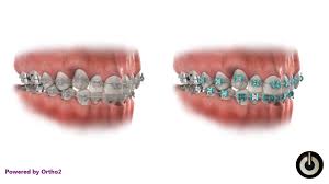 Buy 00 train track and get the best deals at the lowest prices on ebay! Train Track Fixed Braces Tailored For Every Kid S Needs Smile Solutions