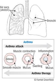 The airways of people with this condition become inflamed, narrowed, and filled with several things can trigger an asthma attack, including stress. Asthma Harvard Health