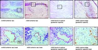 Abdominal Aortic Aneurysm Rupture Is Associated With Increased Medial  Neovascularization and Overexpression of Proangiogenic Cytokines