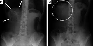 It is chiefly used in the pediatric population. Chilaiditi Syndrome Presenting With Epigastric Pain That Improved By Intentionally Taking The Left Lateral Decubitus Position Shimada 2021 Journal Of General And Family Medicine Wiley Online Library