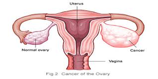 Image result for ovarian cancer