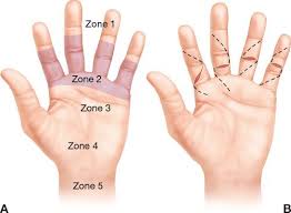 Considerations for zone 1 flexor tendon injuries include surgical approach, tendon retrieval, and tendon repair. Flexor Tendon Repair Plastic Surgery