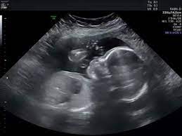 Islami, jawa, modern, kristen nama bayi perempuan islam huruf a. Panduan Lengkap Cara Baca Hasil Usg Dari Arti Warna Hingga Maksud Dari Kode Kode Yang Tertera