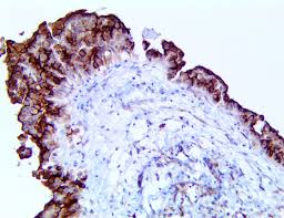 If cancer spreads to the kidneys or adrenal glands, patients may experience low back pain, blood in the urine and anemia. Liver Cancer Archives Bio Sb