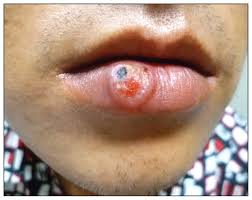 These are very contagious and often painful. Syphilitic Chancre Of The Mouth Cmaj