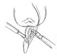 The Appendix Is Freed By Blunt Dissection To Its Base On The Caecum Download Scientific Diagram Download the perfect blunt pictures. freed by blunt dissection to its base