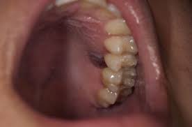 Image result for Canker sores symptoms roof of the mouth